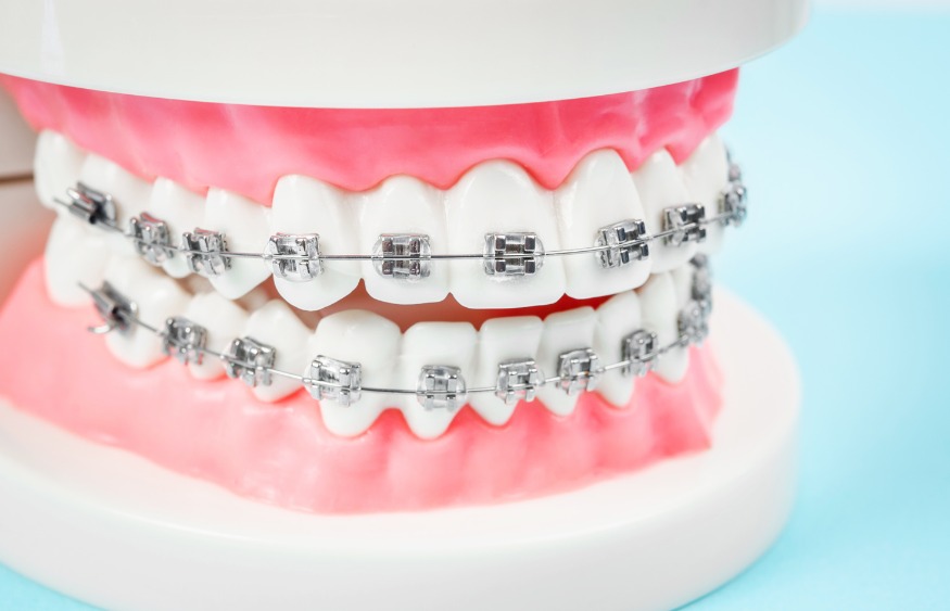 Impact of Braces On Oral Health